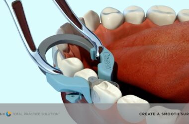 Create-a-Smooth-Surface-with-Palodent-Plus-system-Dentsply-Sirona-Restorative