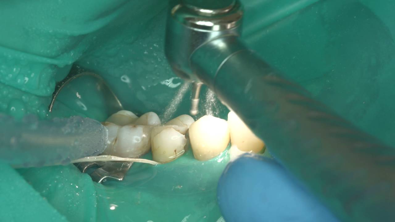 Rubberdam-case-064-II-Class-Palodent-Plus-4K