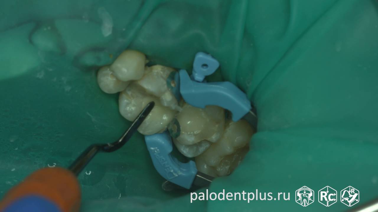 Rubberdam-case-069-II-Class-Palodent-Plus-4K