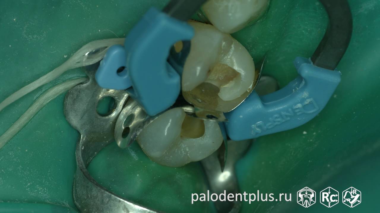 Rubberdam-case-072-II-Class-Palodent-Plus-4K