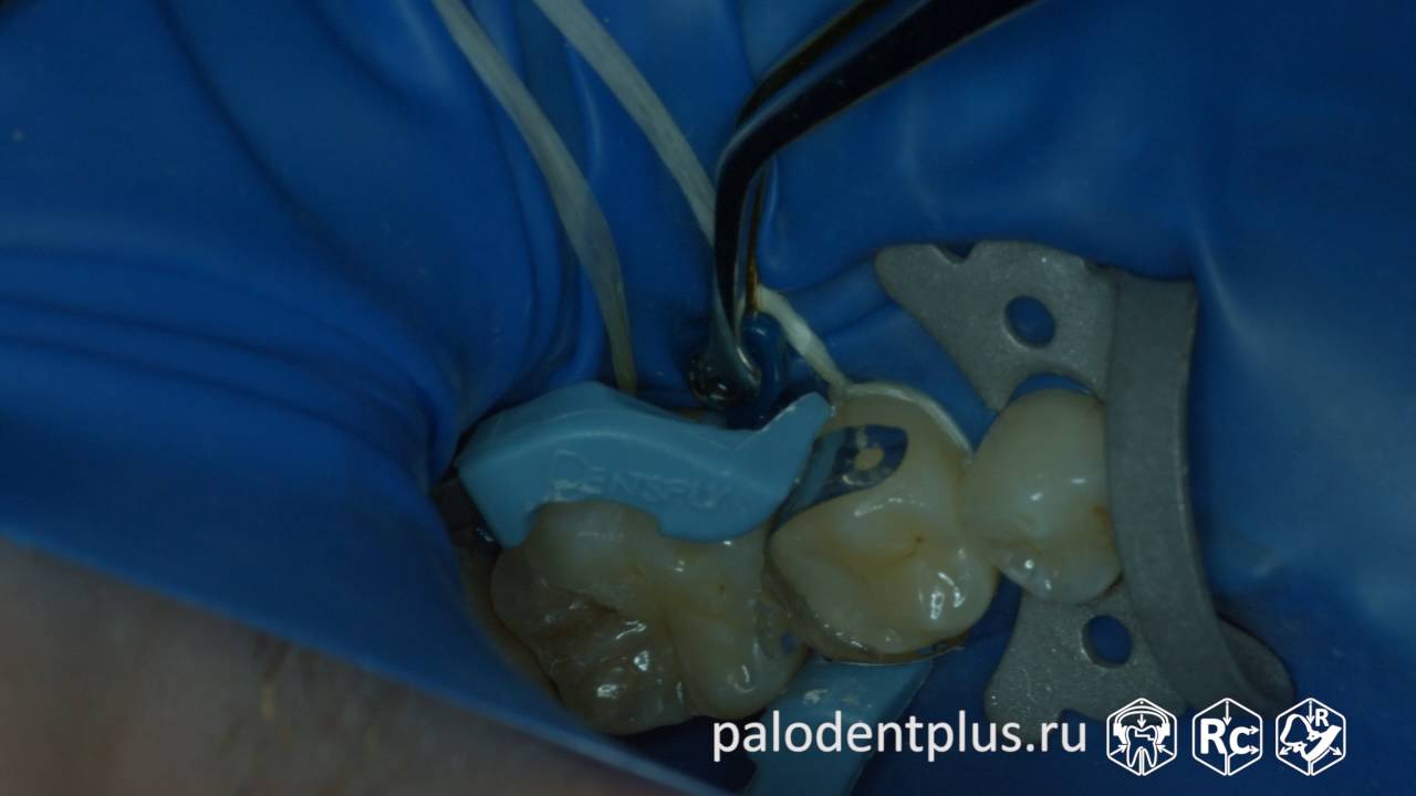 Rubberdam-case-086-II-Class-Palodent-Plus-4K