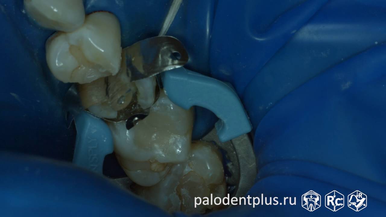 Rubberdam-case-090-II-Class-Palodent-Plus-4K