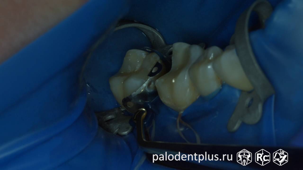 Rubberdam-case-091-II-Class-PalodentPlus-46-47-Rings-Comparsion-4K