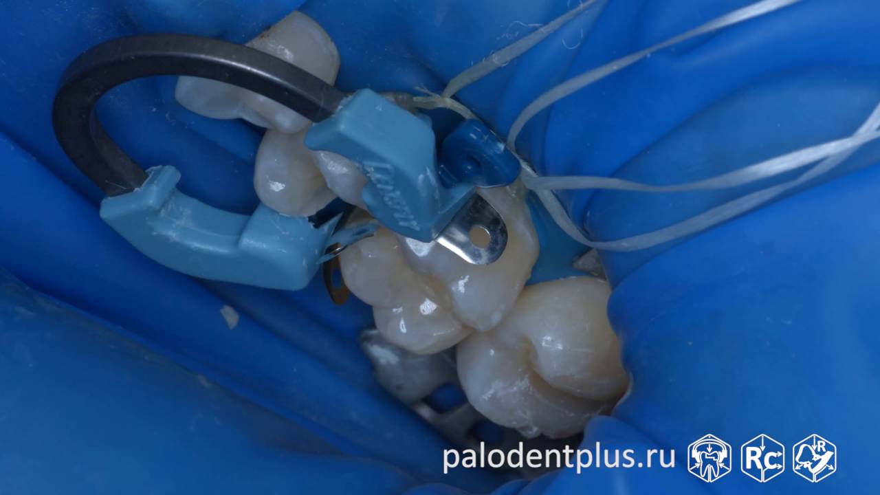 Rubberdam-case-106-II-Class-Palodent-Plus-SDR-4K
