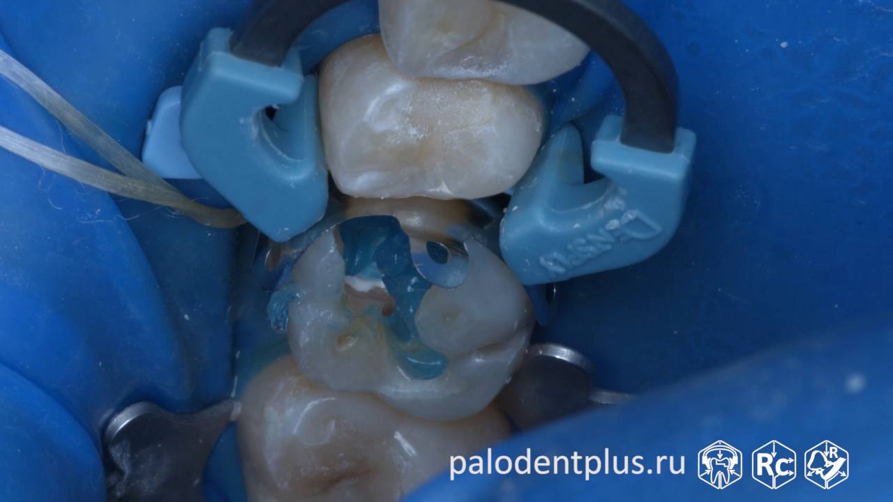 Rubberdam-case-107-II-Class-Palodent-ASH-4K