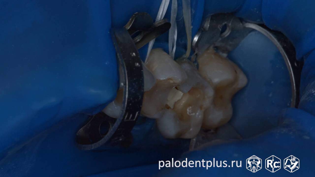 Rubberdam-case-117-25-26-II-Class-Palodent-Plus-ASH-4K