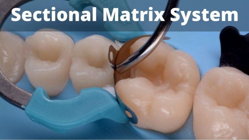 Class-2-restoration-molar-amp-Premolar-Sectional-Matrix-Tips-amp-Tricks-Dentsply-Palodent-amp-Bioclear