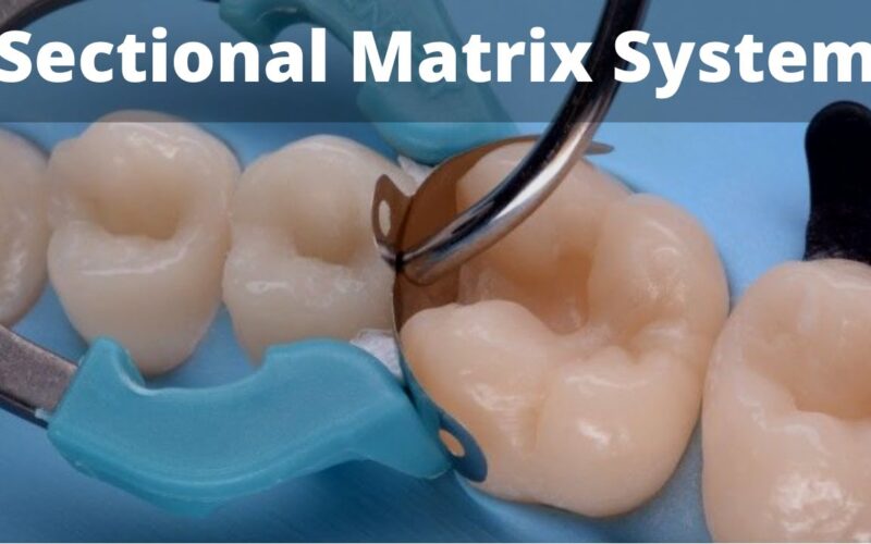 Class-2-restoration-molar-amp-Premolar-Sectional-Matrix-Tips-amp-Tricks-Dentsply-Palodent-amp-Bioclear