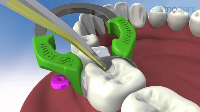 Class-II-composite-restoration-using-V3-Sectional-Matrix-System-Triodent