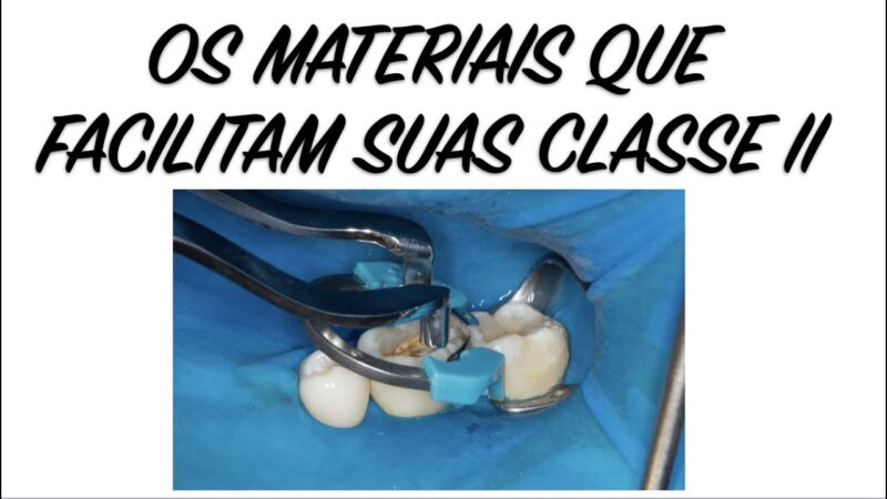 Como-fazer-Restauracoes-Classe-II-com-SDR-matriz-Palodent-e-resina-Spectra-Smart