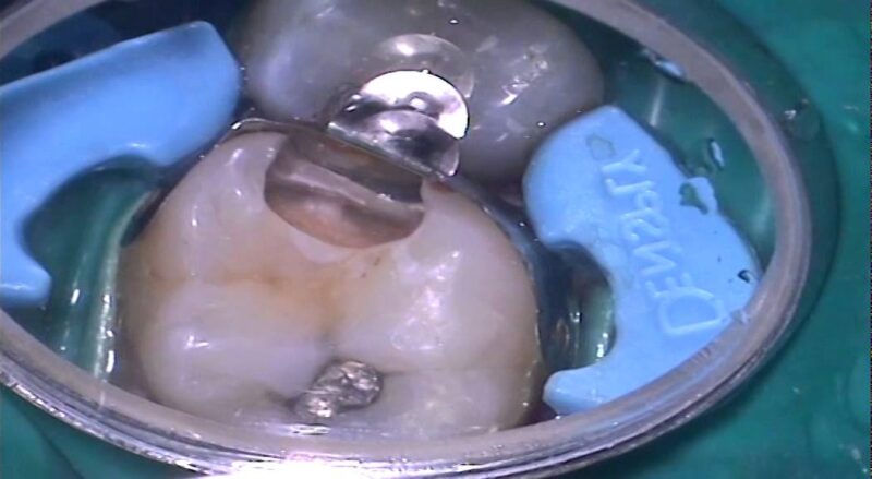 DENTSPLY-UK-Simplified-Posterior-Restorations-Using-Composite-Resins-by-Nick-Barker