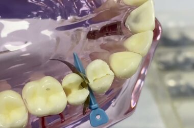 Dental-V-Rings-Palodent-Sectional-Matrix-System