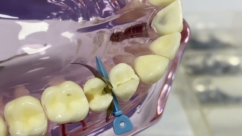 Dental-V-Rings-Palodent-Sectional-Matrix-System