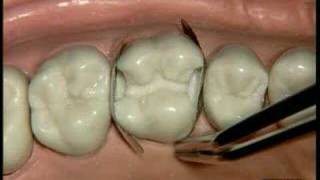 Dentsply-Palodent-Demonstration-on-a-dental-model