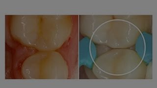 How-To-Get-Tight-Contact-Creation-During-a-Class-II-Dental-Restoration-Dentsply-Sirona