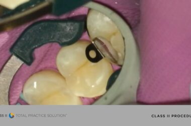 How-to-Perform-a-More-Efficient-Successful-Class-II-Restoration-Dentsply-Sirona