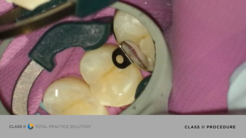 How-to-Perform-a-More-Efficient-Successful-Class-II-Restoration-Dentsply-Sirona