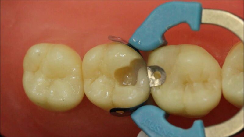 Resinas-Bulk-Fill-Matriz-PALODENT-V3