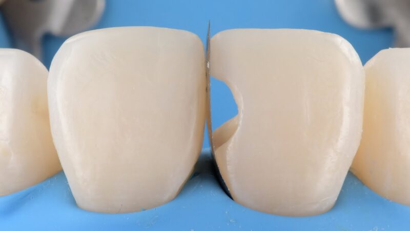 SHAPE-Proximal-Matrix-for-anterior-composite-reconstruction