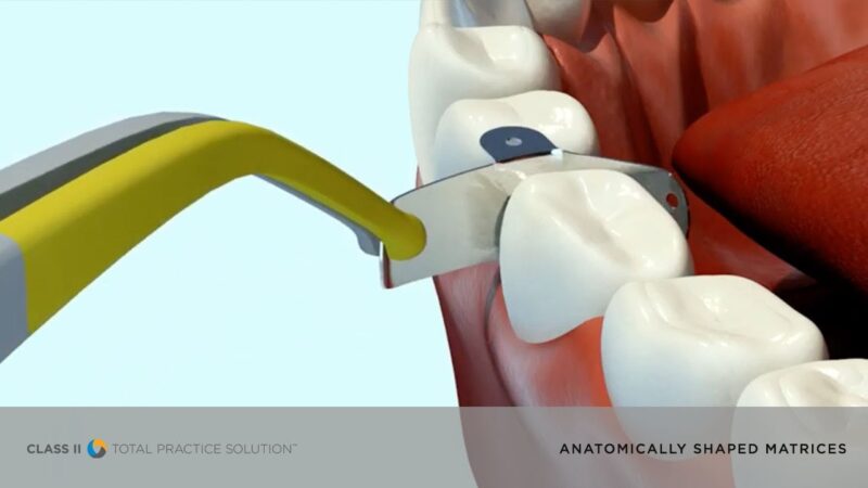 See-How-Anatomically-Shaped-Matrices-Help-in-Class-IIs-Dentsply-Sirona-Restorative