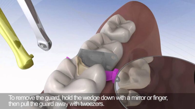 Triodent-WedgeGuard-in-Action