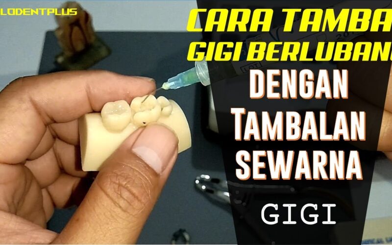 CARA-TAMBAL-GIGI-BERLUBANG-DENGAN-TAMBALAN-SEWARNA-GIGI-MENGUNAKAN-PALODENT-SECTIONAL-MATRICES