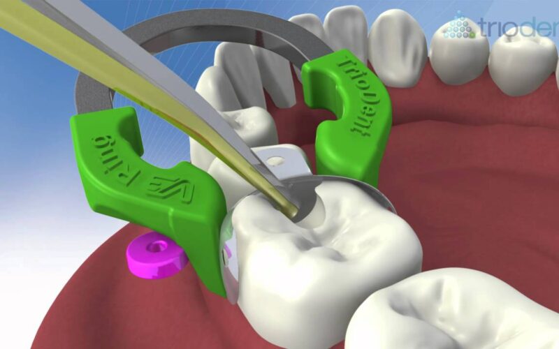 Class-II-composite-restoration-using-V3-Sectional-Matrix-System-Triodent