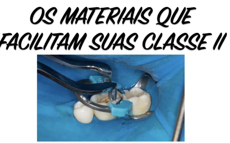 Como-fazer-Restauracoes-Classe-II-com-SDR-matriz-Palodent-e-resina-Spectra-Smart