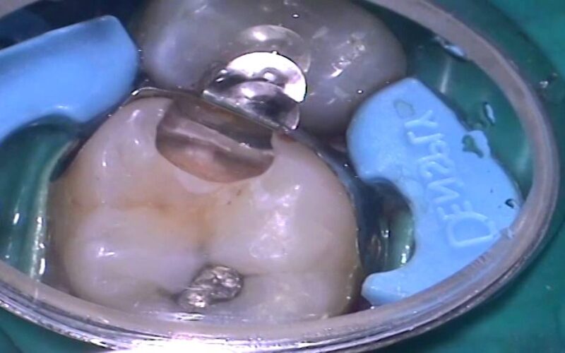 DENTSPLY-UK-Simplified-Posterior-Restorations-Using-Composite-Resins-by-Nick-Barker