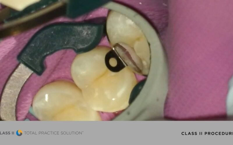 How-to-Perform-a-More-Efficient-Successful-Class-II-Restoration-Dentsply-Sirona