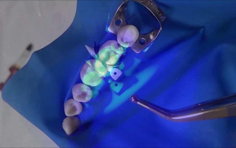 Matriz-Palodent.-Demonstracao.-Palodent-Introdutory-Kit.-Demonstration