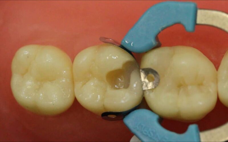 Resinas-Bulk-Fill-Matriz-PALODENT-V3