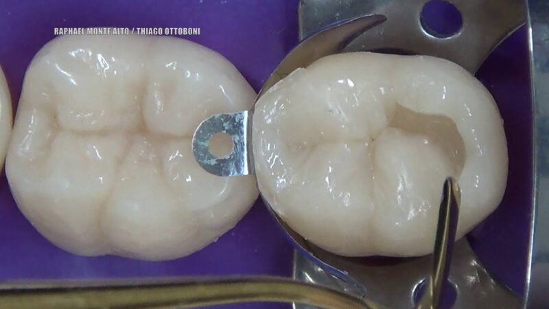 Restauracao-em-resina-Classe-II-Matriz-Palodent-V3