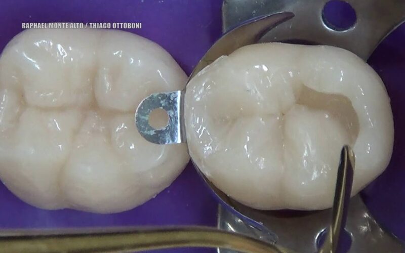 Restauracao-em-resina-Classe-II-Matriz-Palodent-V3