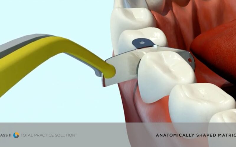 See-How-Anatomically-Shaped-Matrices-Help-in-Class-IIs-Dentsply-Sirona-Restorative