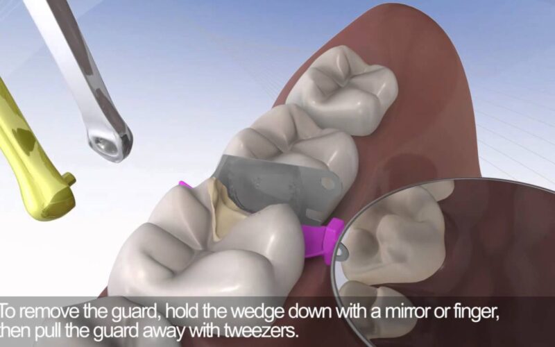 Triodent-WedgeGuard-in-Action