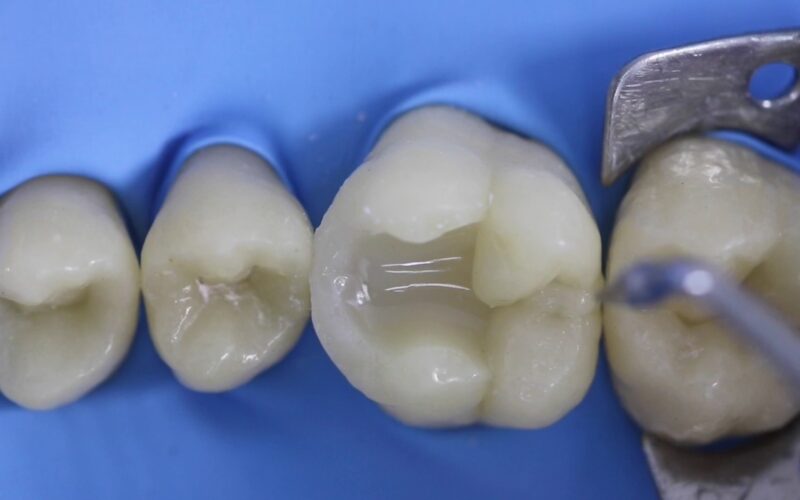 Utilizacao-da-Matriz-Palodent-V3-DentsplySirona