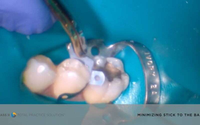 Watch-How-our-EZ-Coat-Matrix-Minimizes-Stick-to-the-Band-Dentsply-Sirona-Restorative